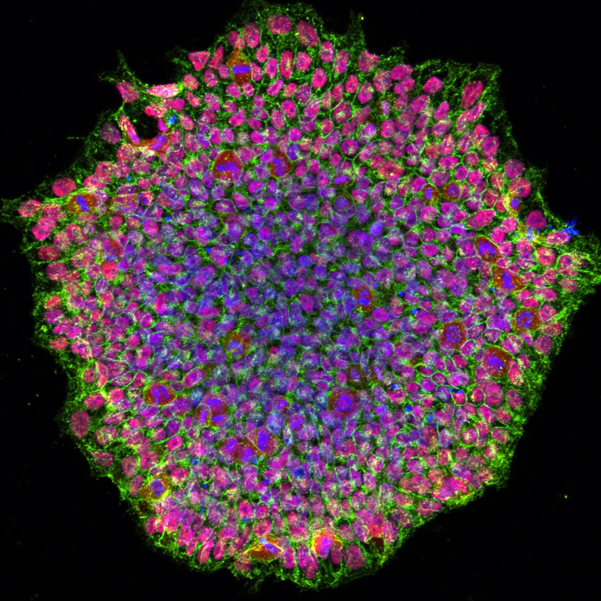 Researchers at NIH's National Eye Institute (NEI) developed the first patient-derived stem cell model for studying eye conditions related to oculocutaneous albinism (OCA). Learn more: at https://www.n